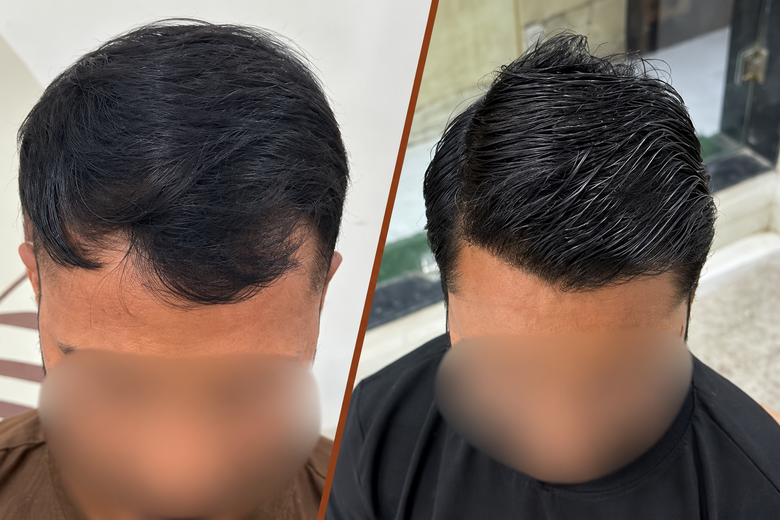 Cosmetic Procedure Before and After